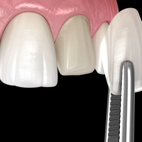 Illustration of veneer being placed on prepared tooth