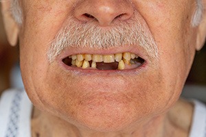 A closeup of an unhealthy smile with missing teeth
