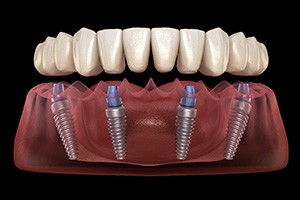 Digital image of implant denture