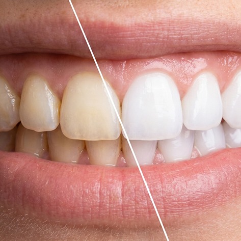 Close-up of person’s smile before and after teeth whitening